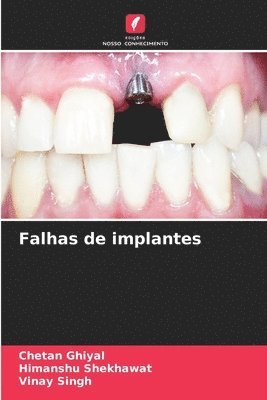 Falhas de implantes 1