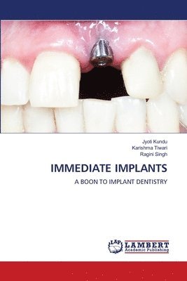 Jyoti Kundu, Karishma Tiwari, Ragini Singh - Immediate Implants, Häftad