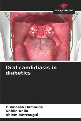 bokomslag Oral candidiasis in diabetics