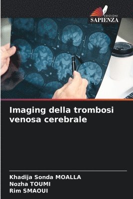 Khadija Sonda Moalla, Nozha Toumi, Rim Smaoui, Khadija Sonda MOALLA - Imaging della trombosi venosa cerebrale, Häftad
