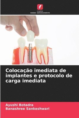 bokomslag Colocao imediata de implantes e protocolo de carga imediata