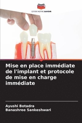 Mise en place immédiate de l'implant et protocole de mise en charge immédiate