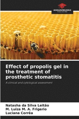 bokomslag Effect of propolis gel in the treatment of prosthetic stomatitis