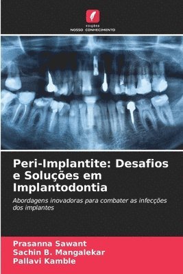 Peri-Implantite: Desafios e Soluções em Implantodontia 1