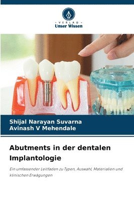 bokomslag Abutments in der dentalen Implantologie