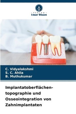 C Vidyalakshmi, S C Ahila, B Muthukumar, C. Vidyalakshmi, S. C. Ahila - Implantatoberflächen- topographie und Osseointegration von Zahnimplantaten, Häftad
