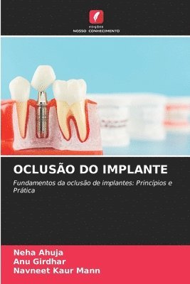 Oclusão Do Implante