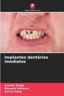 bokomslag Implantes dentários imediatos