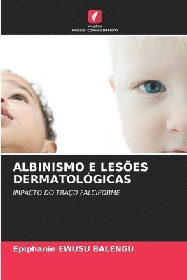 Epiphanie Ewusu Balengu, Epiphanie EWUSU BALENGU - Albinismo E Lesões Dermatológicas, Häftad