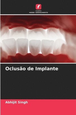 Abhijit Singh - Oclusão de Implante, Häftad