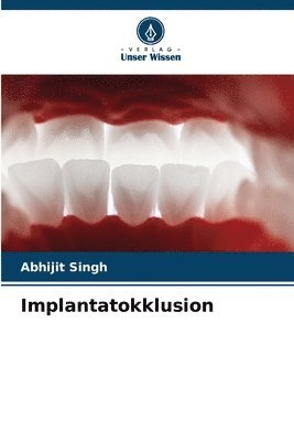 Abhijit Singh - Implantatokklusion, Häftad
