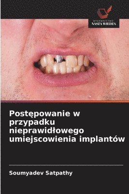 bokomslag Post¿powanie w przypadku nieprawid¿owego umiejscowienia implantów