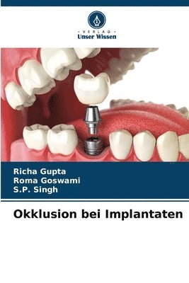 Richa Gupta, Roma Goswami, S P Singh, S. P. Singh - Okklusion bei Implantaten, Häftad