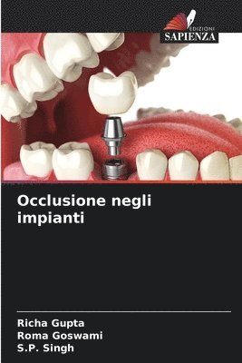 bokomslag Occlusione negli impianti