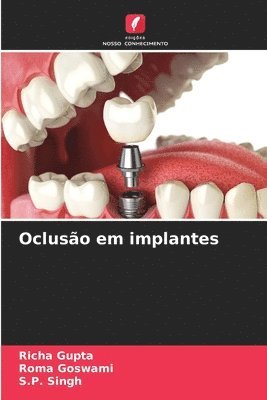 bokomslag Oclusão em implantes