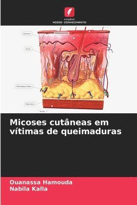 bokomslag Micoses cutâneas em vítimas de queimaduras