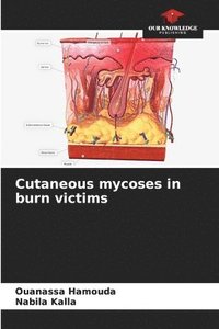 bokomslag Cutaneous mycoses in burn victims