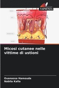 bokomslag Micosi cutanee nelle vittime di ustioni