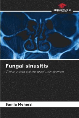 bokomslag Fungal sinusitis