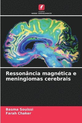bokomslag Ressonância magnética e meningiomas cerebrais