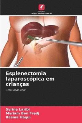 Syrine Laribi, Myriam Ben Fredj, Basma Hagui - Esplenectomia laparoscópica em crianças, Häftad