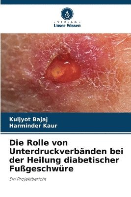 Rolle von Unterdruckverbänden bei der Heilung diabetischer Fußgeschwüre