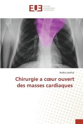 Chirurgie a coeur ouvert des masses cardiaques