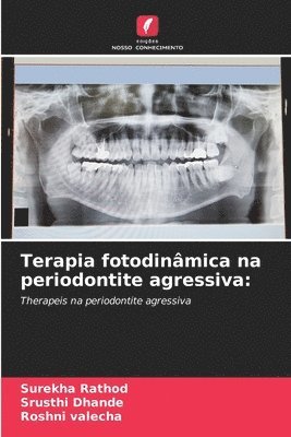 Terapia fotodinâmica na periodontite agressiva