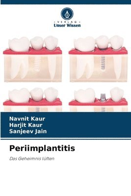Periimplantitis