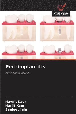 Peri-implantitis