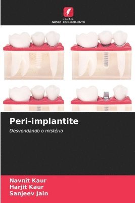 Peri-implantite