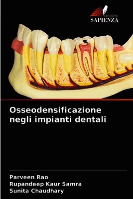 Osseodensificazione negli impianti dentali