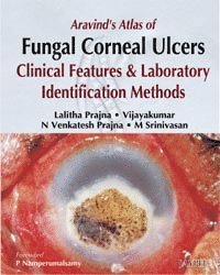 Lalitha Prajna, Vijayakumar, N Venkatesh Prajina, M Srinivasan, Vijayakumar, - Aravind's Atlas of Fungal Corneal Ulcers, Inbunden