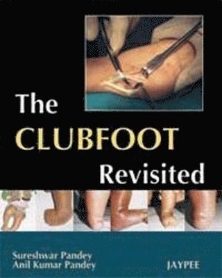 bokomslag Club Foot Revisited
