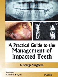bokomslag Practical Guide to the Management of Impacted Teeth