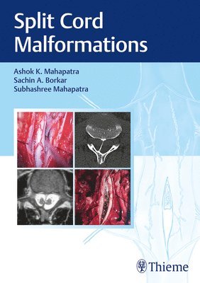 Ashok Mahapatra, Sachin Borkar, Subhashree Mahapatra - Split Cord Malformations, Inbunden