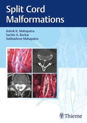 Split Cord Malformations 1