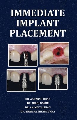 Aadarsh Dhan - Immediate Implant Placement, Häftad. Tillgänglighet: Lägg i varukorg