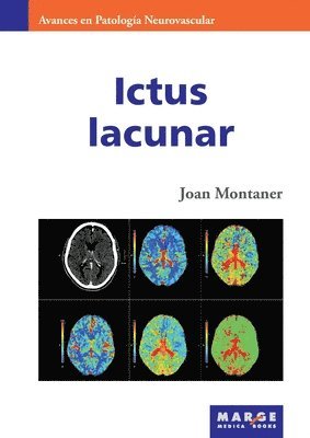 Ictus lacunar 1