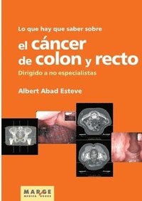 bokomslag Lo que hay que saber sobre el cáncer de colon y recto