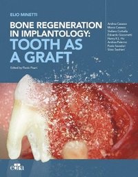 bokomslag Bone regeneration in implantology - tooth as a graft