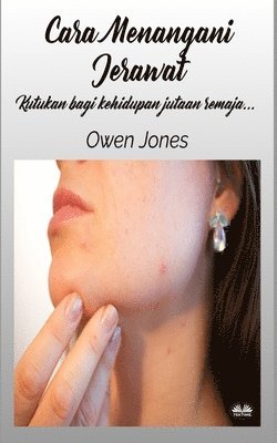 Cara Menangani Jerawat 1