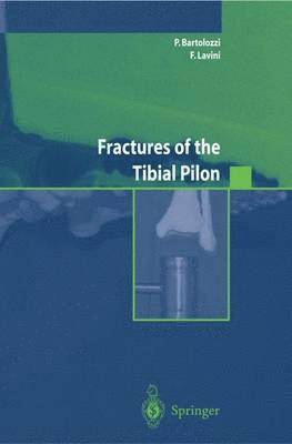 Fractures of the Tibial Pilon 1