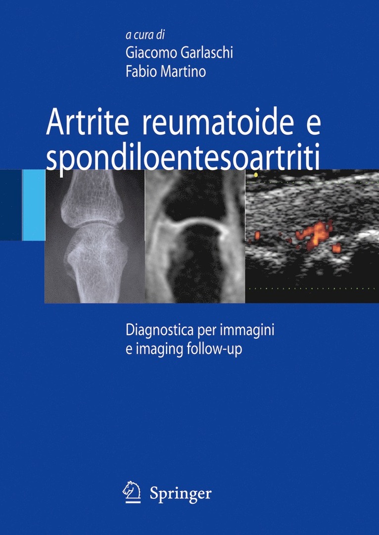 Artrite reumatoide e spondiloentesoartriti