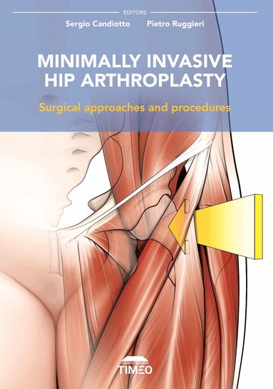 Sergio Candiotto, Pietro Ruggieri - Minimally Invasive Hip Arthroplasty, Inbunden