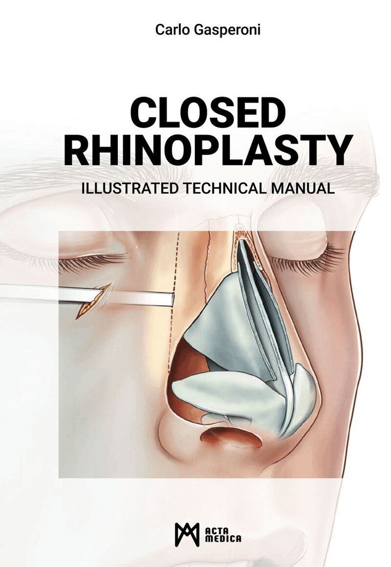 Carlo Gasperoni - Closed Rhinoplasty, Inbunden