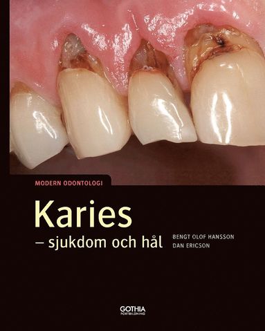 bokomslag Karies : sjukdom och hål