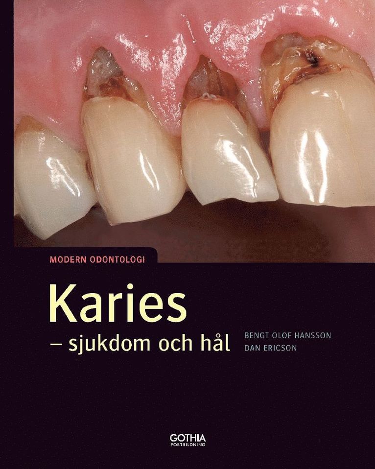 Bengt Olof Hansson, Dan Ericson - Karies : sjukdom och hål, Häftad