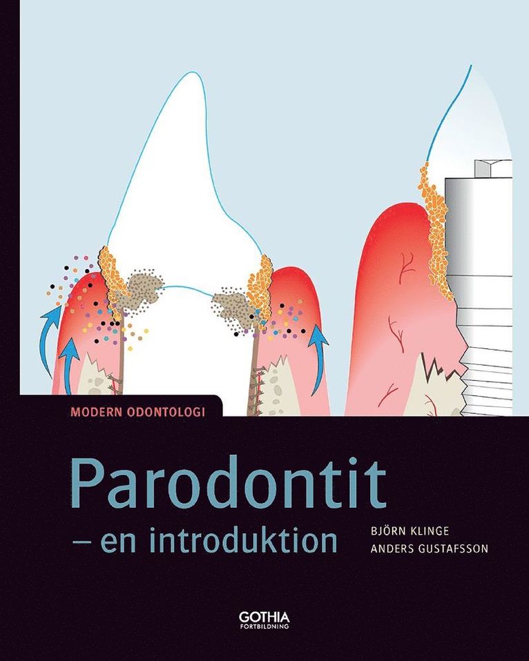 Björn Klinge, Anders Gustafsson - Parodontit : en introduktion, Häftad