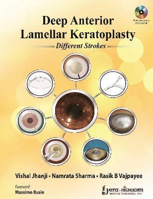 Deep Anterior Lamellar Keratoplasty Different Strokes 1